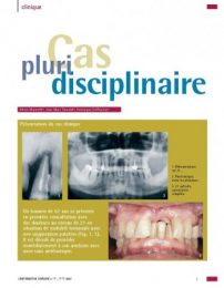 chirurgie-avant-implants_Page_1-349×500 chirurgie-avant-implants_Page_1-349x500